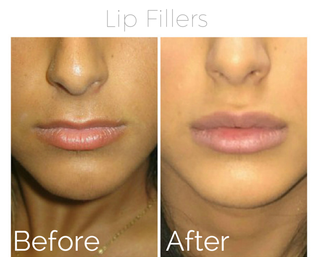 Filler - lips 3.png