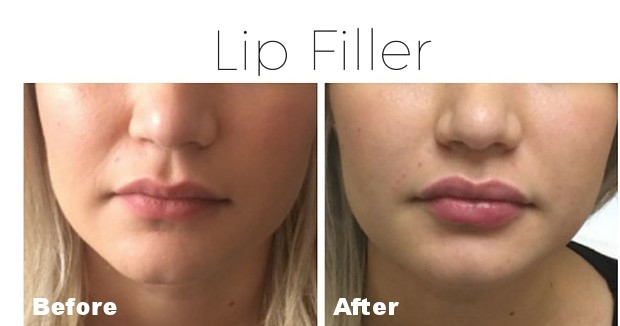 Filler - lips 4.jpg
