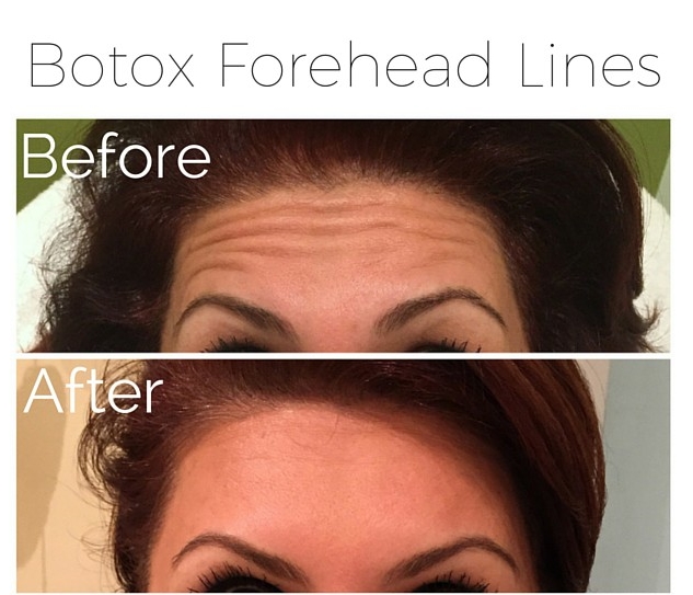 Botox - forehead lines.jpg