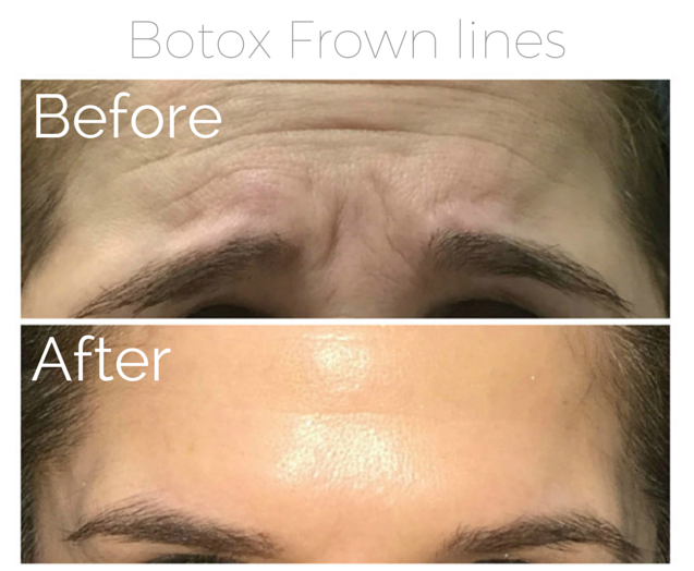 Botox - Frown lines 2.png