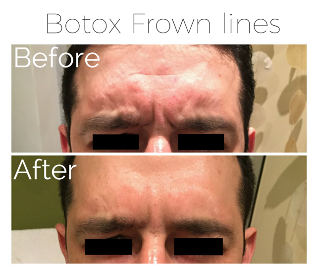 Botox - Frown lines 3.png