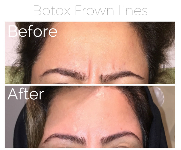 Botox - Frown lines.png