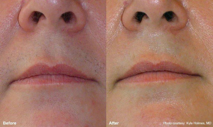 upper_lip_1.jpg