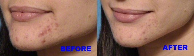 Acne-Treatment- microneedling - before after.jpg