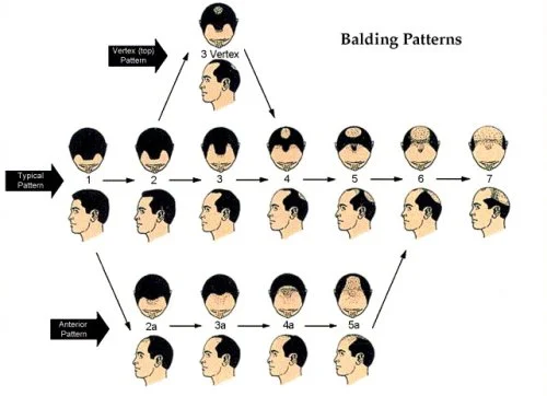 Male - hair loss pattern.jpg