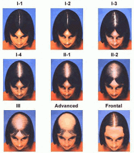 Female-Hair-Loss-101-Savin-Scale-image.gif