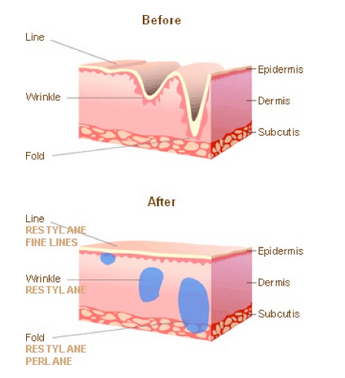 dermal_fillers_work.png