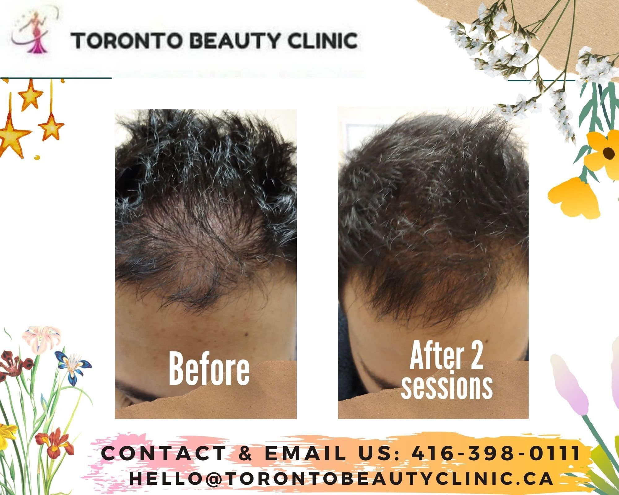 PRP HAir restoration Before after 1.jpeg