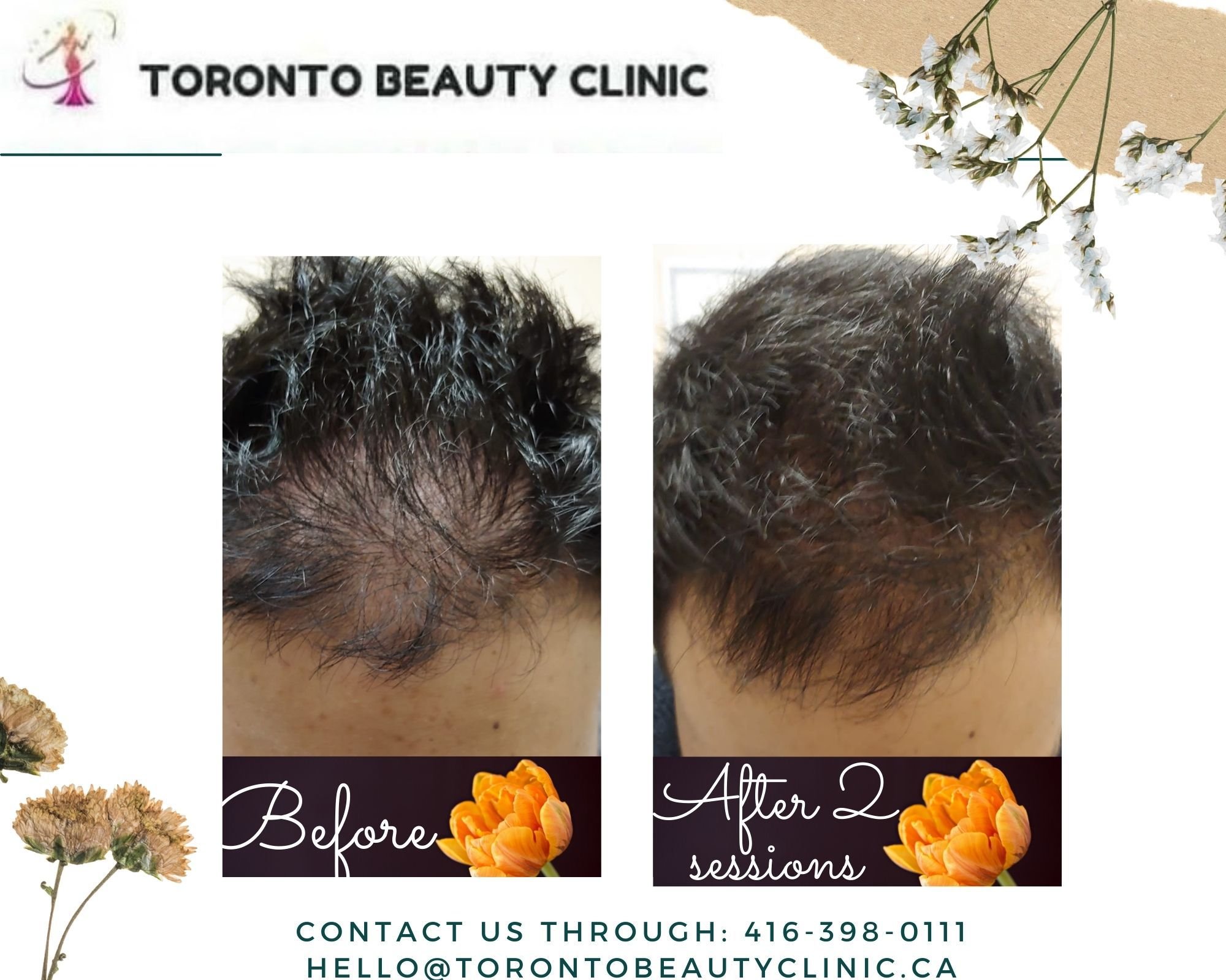 PRP HAir restoration Before after 3.jpeg