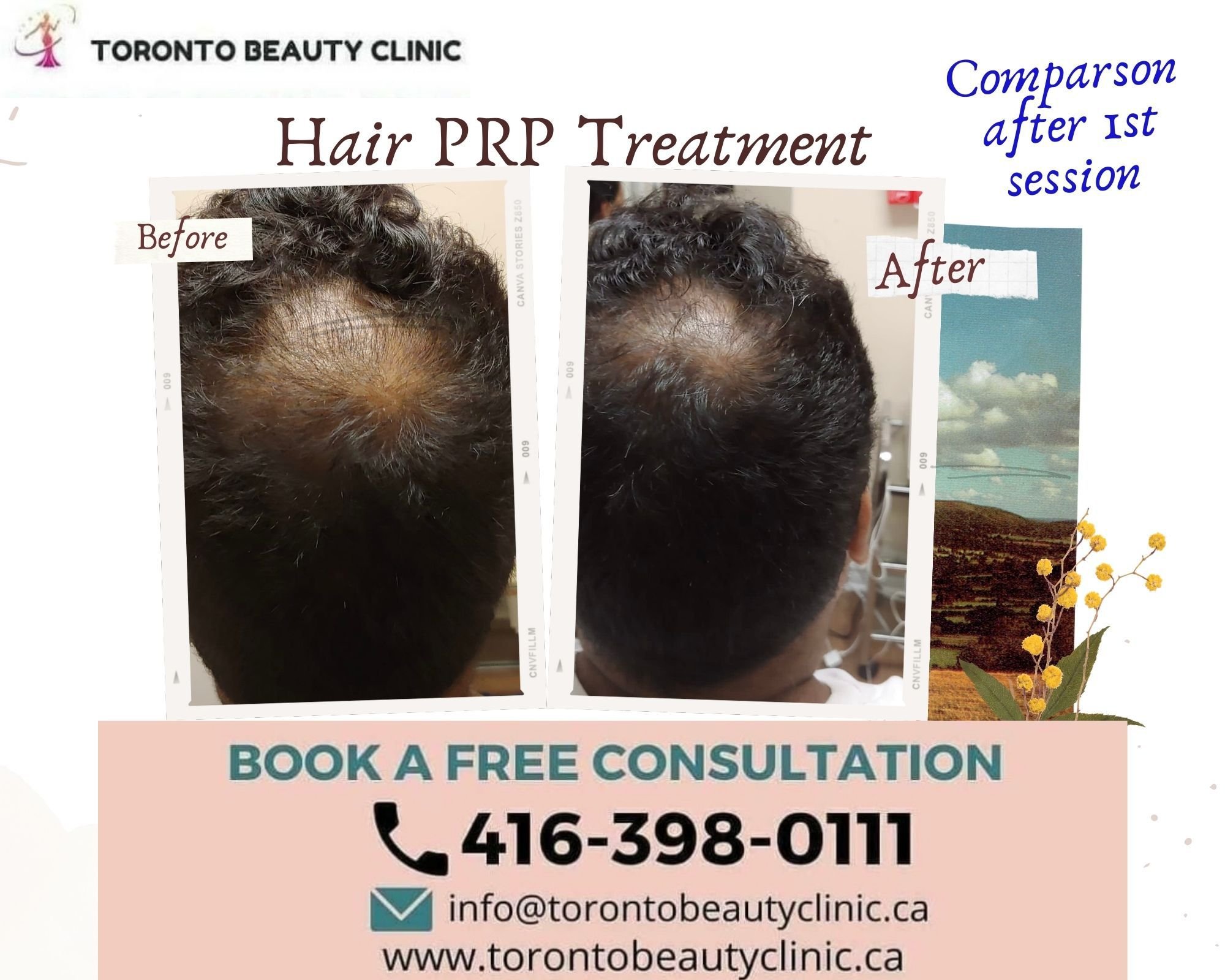 PRP HAir restoration Before after 4.jpeg