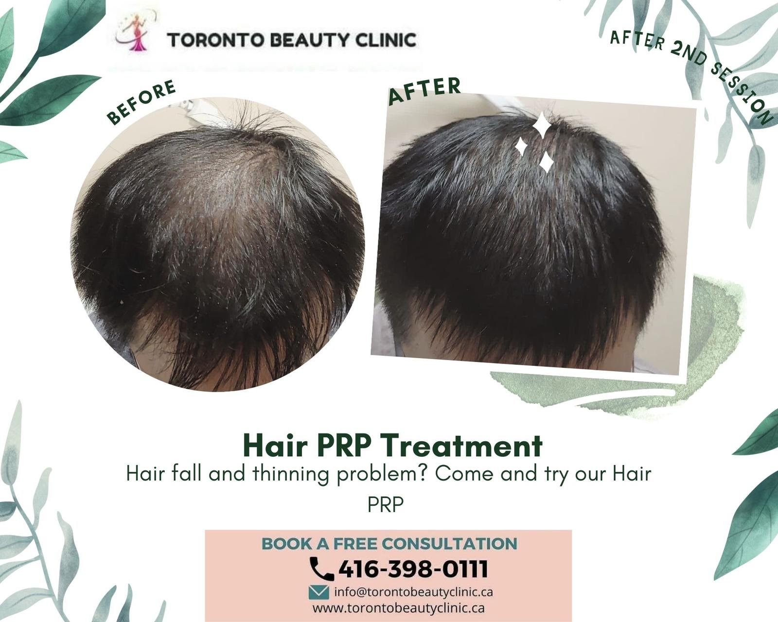 PRP HAir restoration Before after 5.jpeg