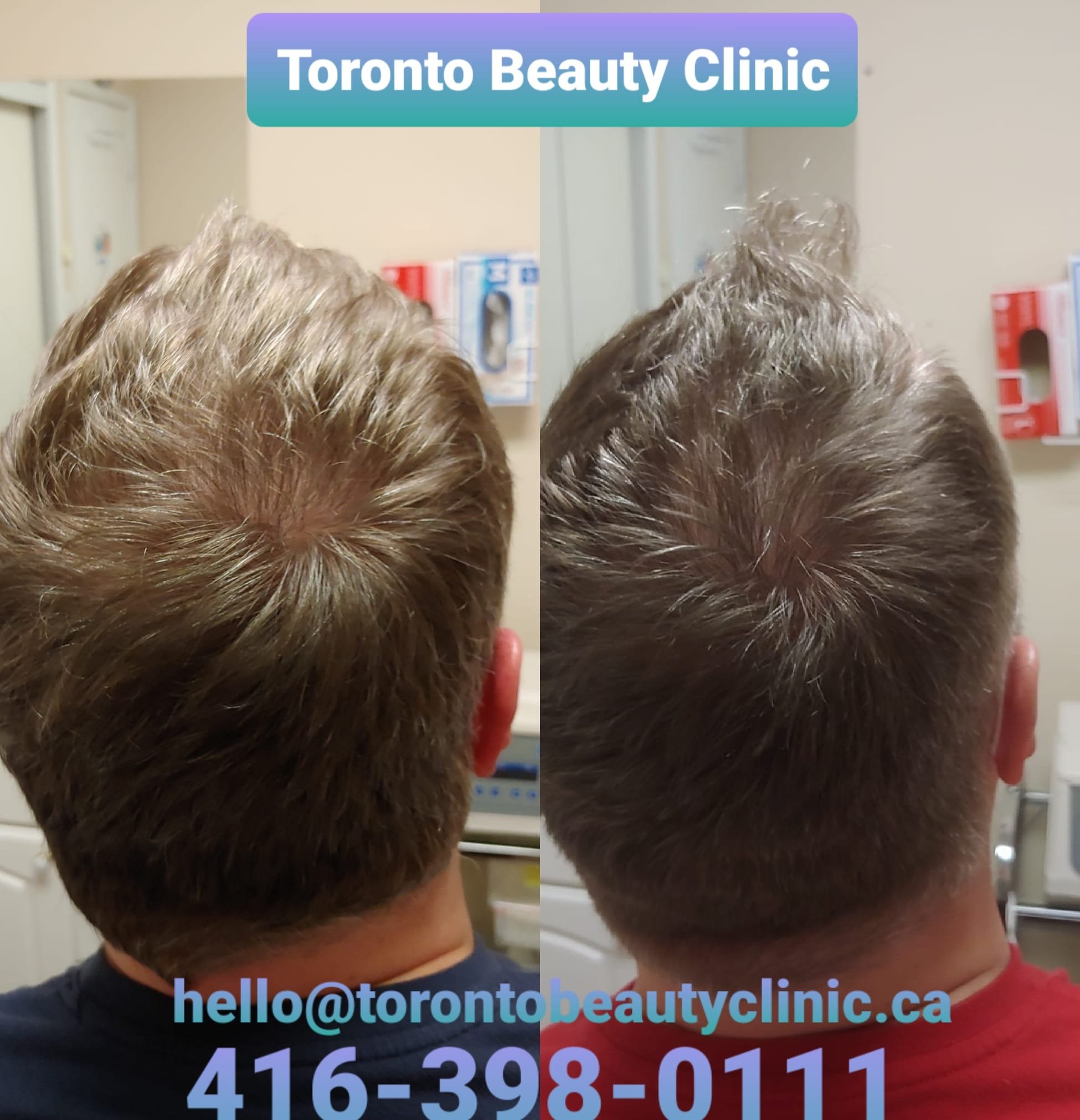 PRP HAir restoration Before after 6.jpeg