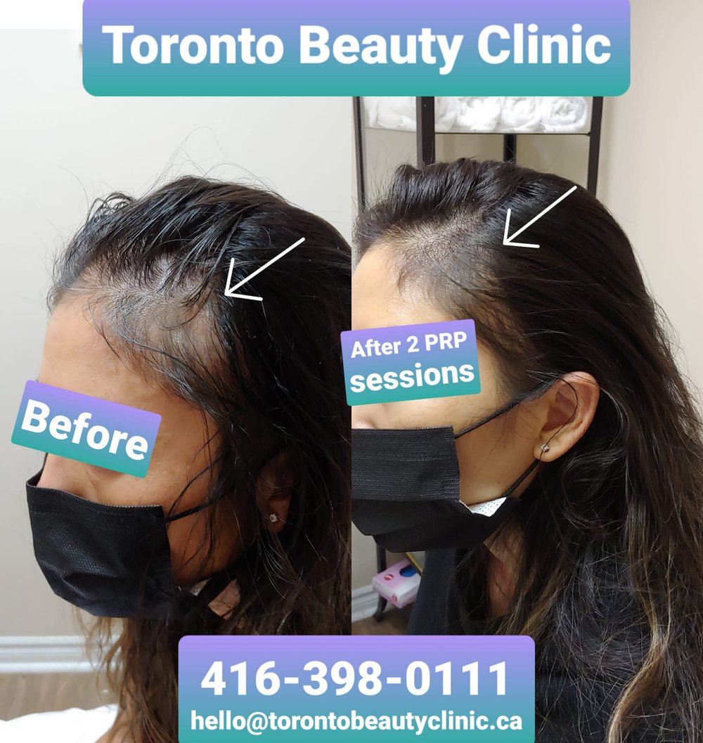 Toronto Hair Loss Treatment With PRP | Promo $599/Session