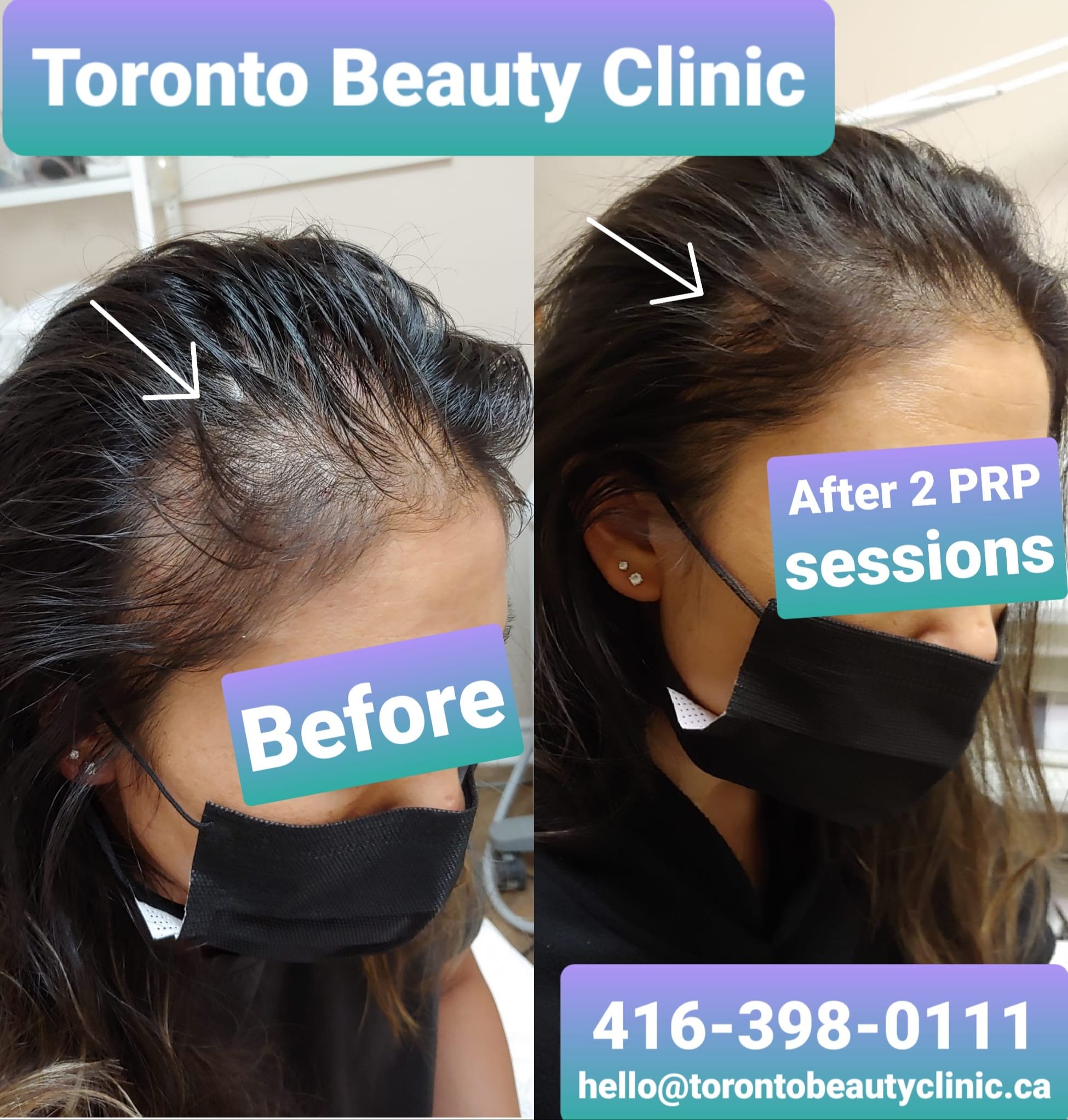 PRP HAir restoration Before after 8.jpeg