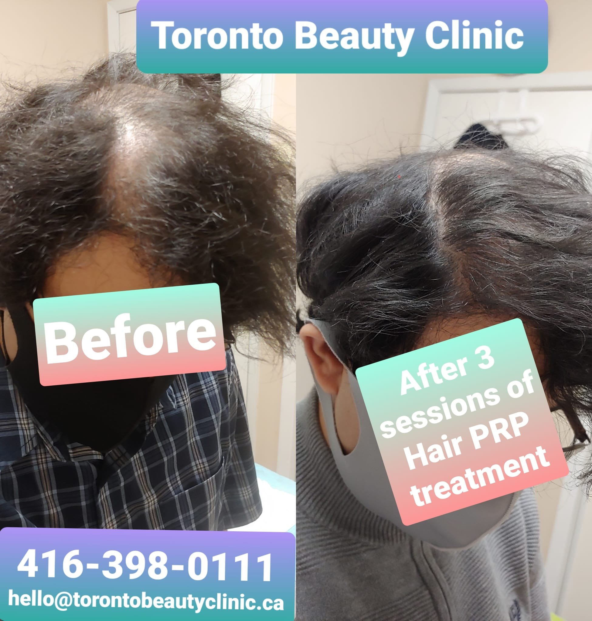 PRP HAir restoration Before after 9.jpeg