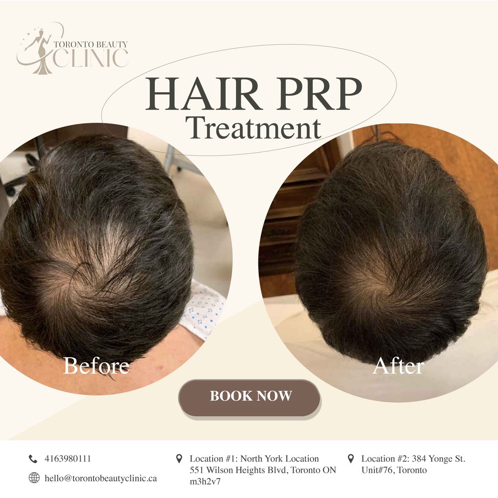 Toronto Hair Loss Treatment With PRP | Promo $599/Session