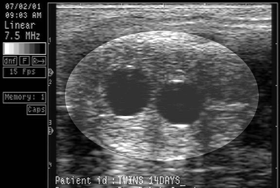 Ultrasound image of two vesicles present in within the uterus (consistent with twins)