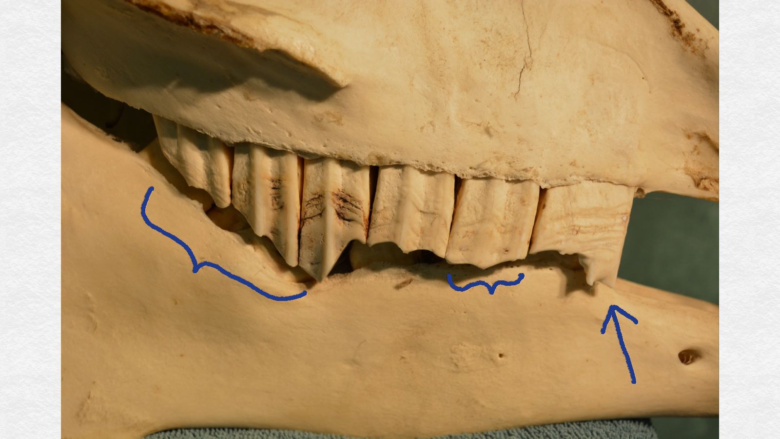 The affected side. The back three teeth (left of the image, long blue bracket) are sloping toward the wedge-shaped overgrowth. The second cheek tooth (short blue bracket) is a little too long, and there is a prominent "hook" at the front of the first cheek tooth (blue arrow). The wedge-like overgrowth of the fourth cheek tooth "locked" the upper jaw a little forward of its normal position, so there was nothing to grind against the front of the first cheek tooth, hence the development of the "hook."
