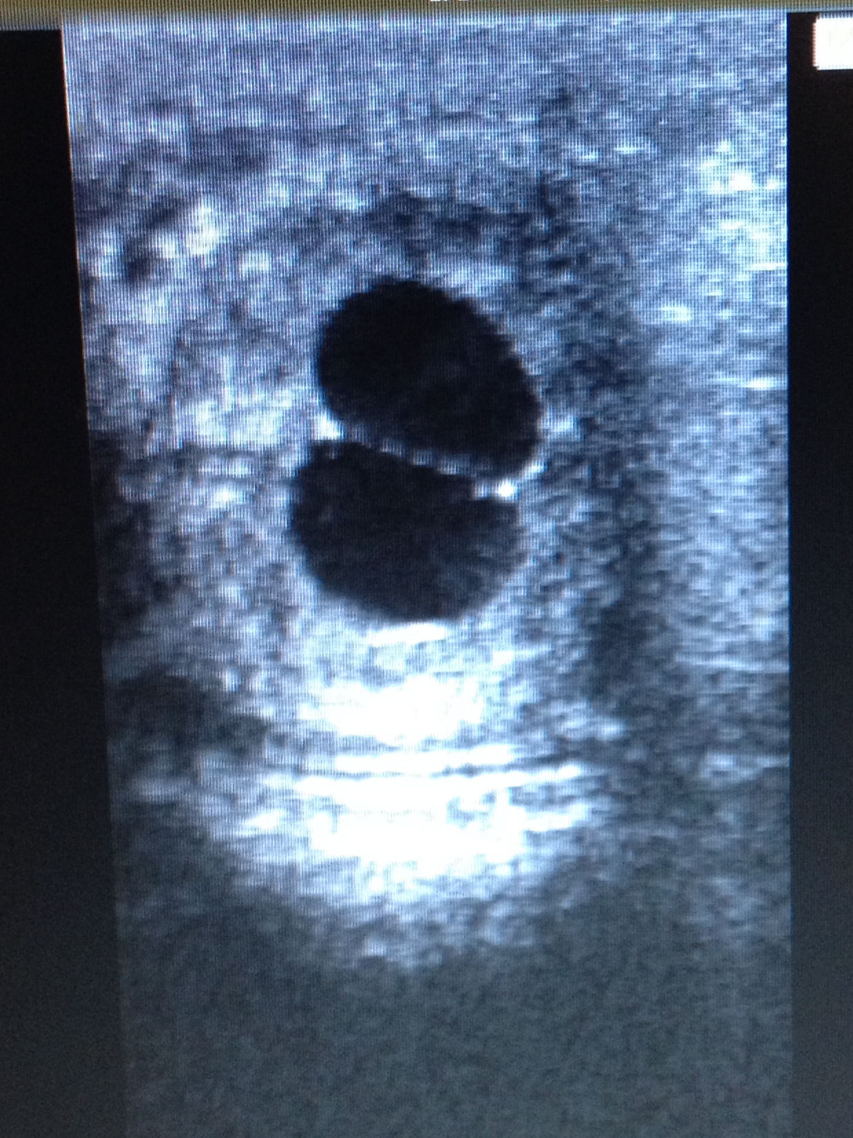 Ultrasound image of twin embryos in a mare at approximately 17 days gestation.