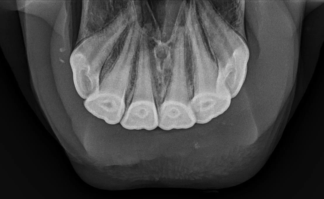 X-ray of normal incisors in a mare in her upper teens. Note the tapered, well defined roots