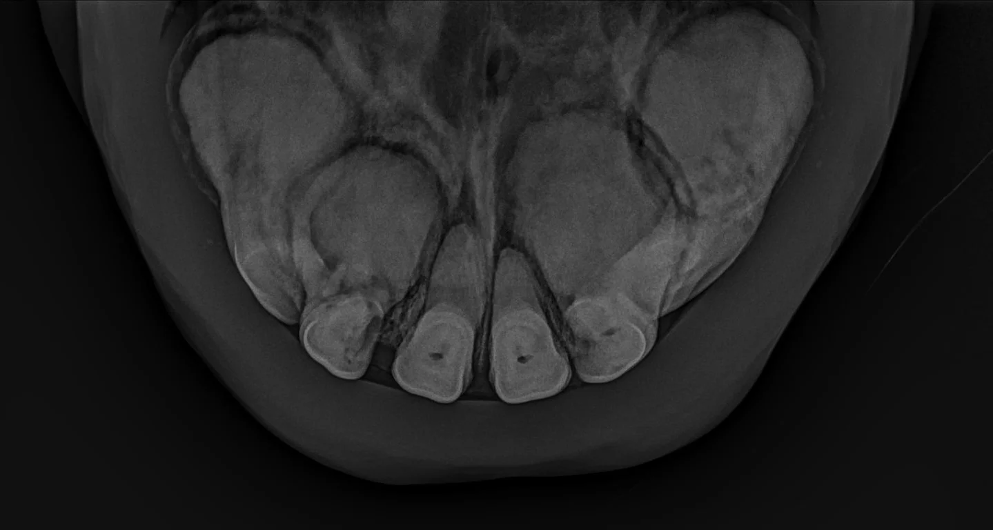 A clinical case of EOTRH in a gelding in his mid twenties. Note the irregular and bulbous appearance of the roots, especially the outside incisors with less involvement of the middle incisors. The bone surrounding the roots also looks irregular.