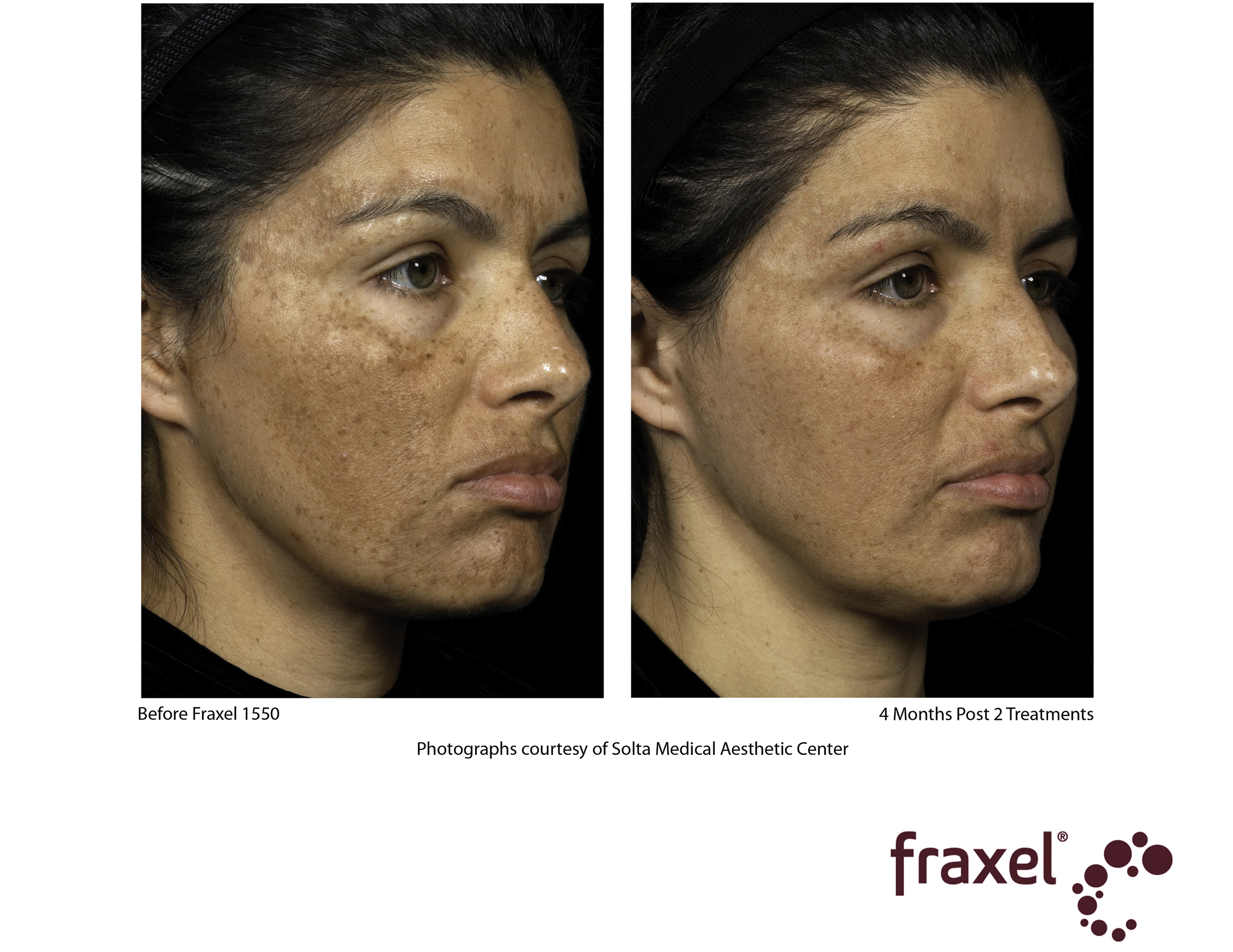 E006-Fraxel_1550_HiRes.jpg