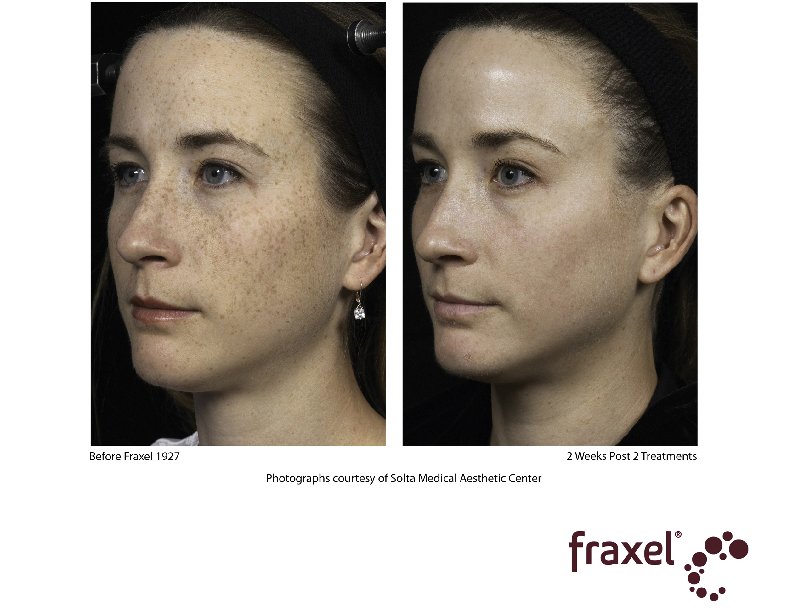 Fraxel face 5.jpg