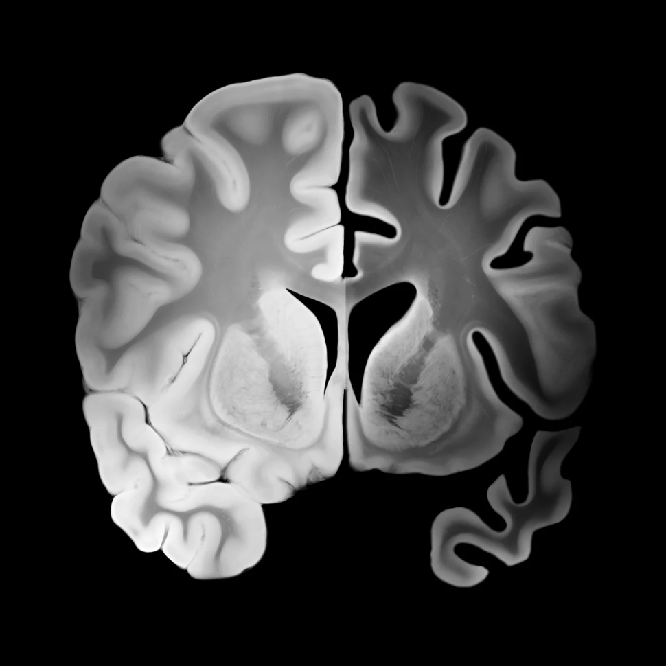 Can NAD+ Reverse Alzheimer’s Disease? New Research Offers Hope 