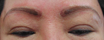 2 months later-a combination of exfoliating and camouflage is needed to reduce the amount of the pigment.