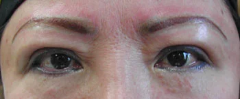 6 months later- minimal camouflage, the shape and color is better. She may require future treatments to maintain the soft look of the brows. She is pleased with the results at this time.