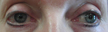 very poorly placed eyeliner, approximately 10+years old