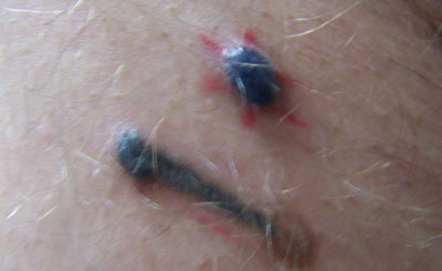 1) The blue tattoo color began as 2 round filled areas but began to grow and harden, similar to a keloid, or large mole in texture, approximately 6 months after the tattoo. It was painful to the client, so removal was the desired treatment. Note: red, green and brown pigments did not have the same reaction. Bump #1 has red pigment radiating out. (Approximately 8cc across) Bump #2 has a blue-green stem. (Approximately 5cc across)
