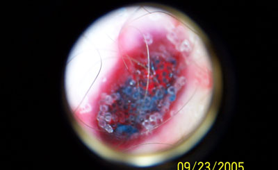 3) Bump #1 Magnified, blue pigment is visibly exposed, and much was exfoliated.