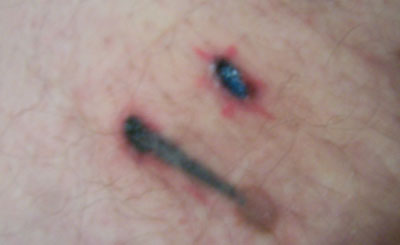 4) Less than 1 day after, both the bumps and the pain were gone.