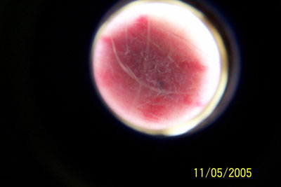 8) Bump #1 Under bright light and magnification, the skin is still healing, but the pain is completely gone.