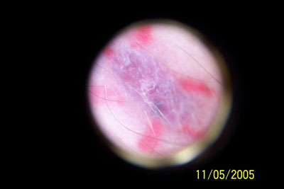 10) Bump #1 The area has very little trauma, and expect to have little to no noticible scarring.