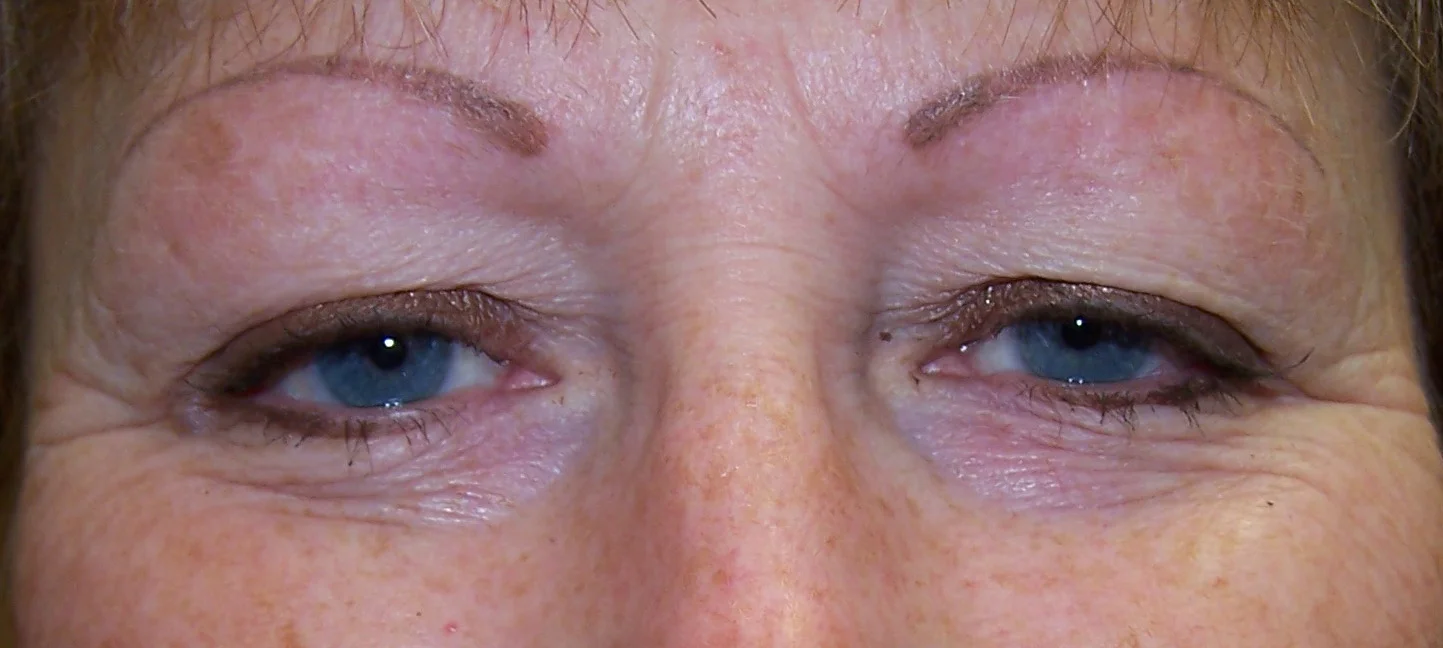brows 12 after her procedure.jpg