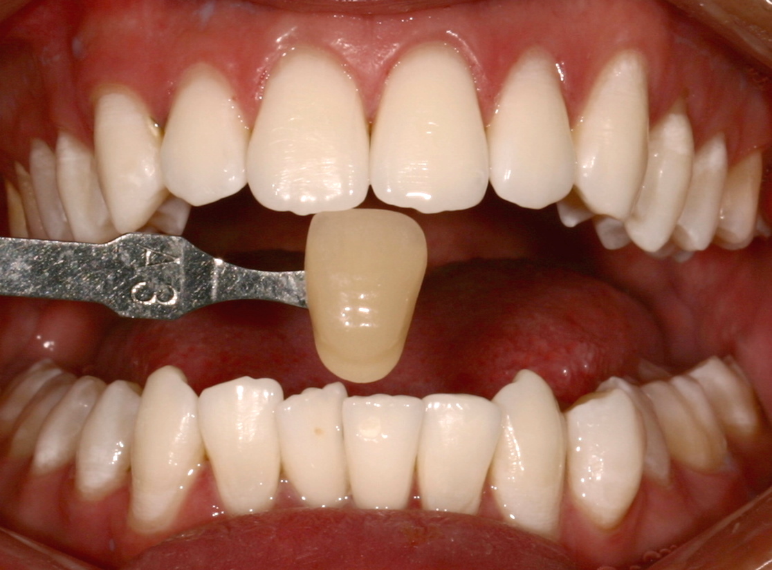 golden valley teeth whitening 2