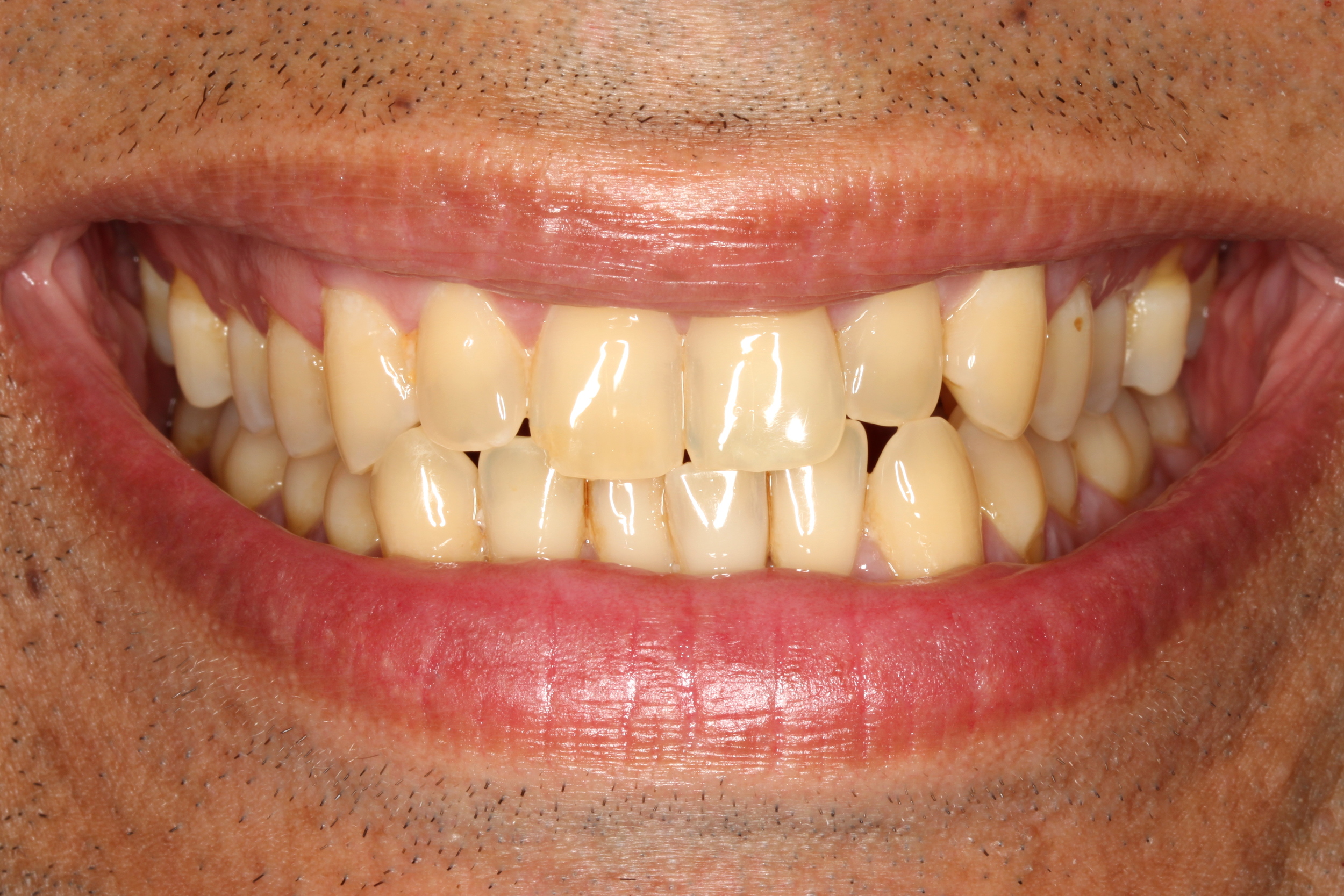 yellowed teeth