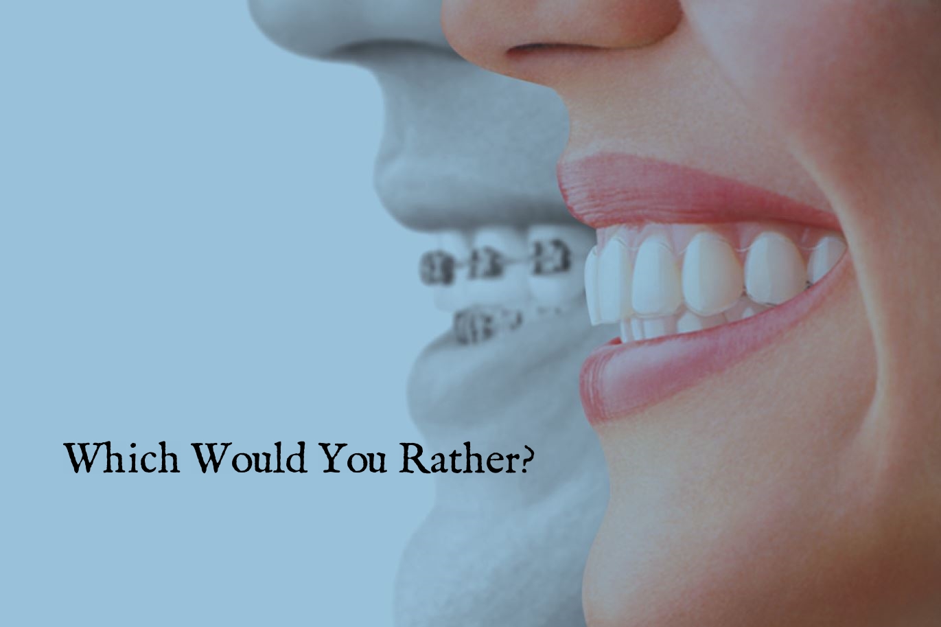 Braces comparison