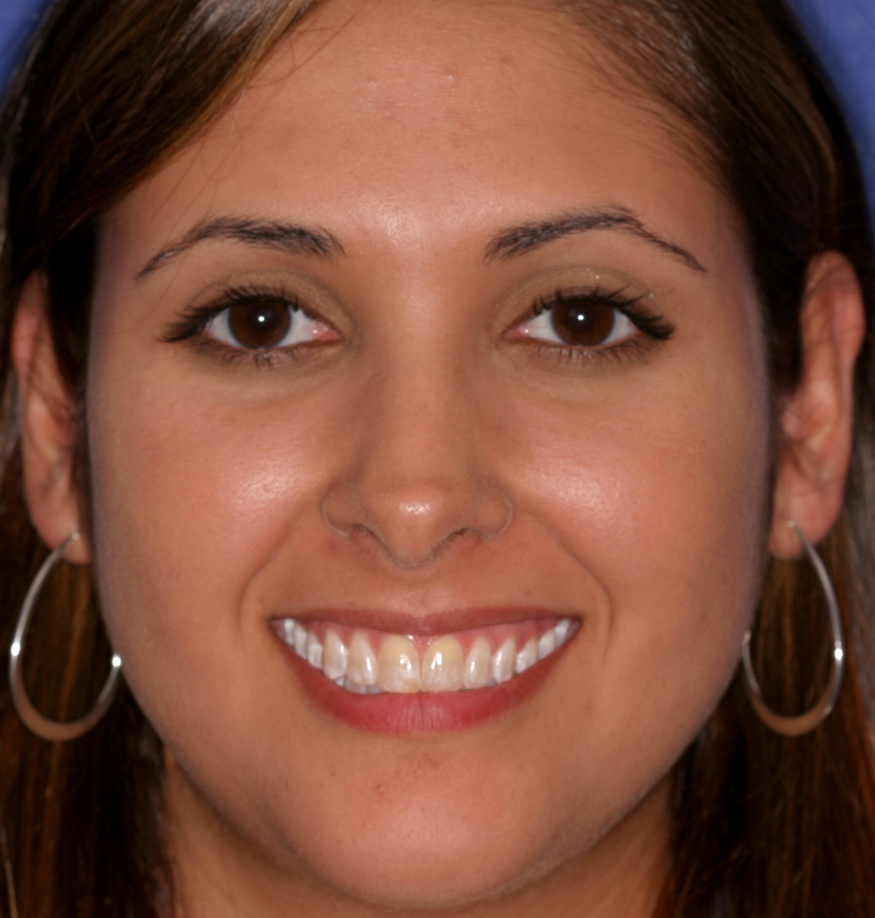 before whitening treatment