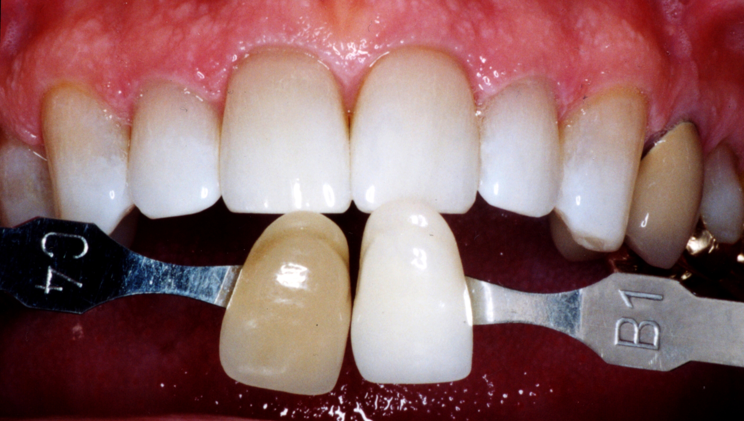 perfect white teeth after