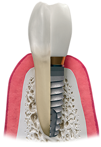 Dental Implant