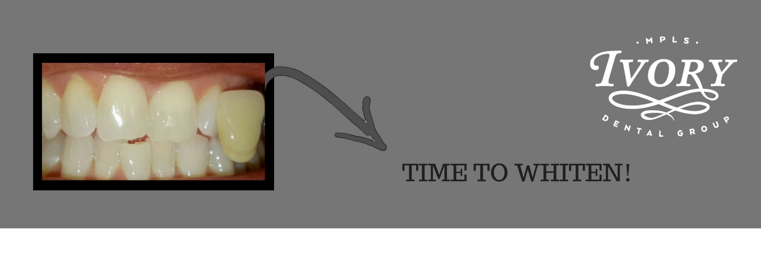 teeth whitening