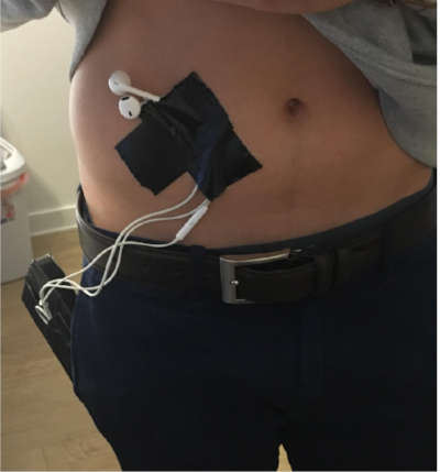 An example of a mock-up worn by team members to try and empathize with the difficulties and frustrations felt by users of existing insulin pump technology.