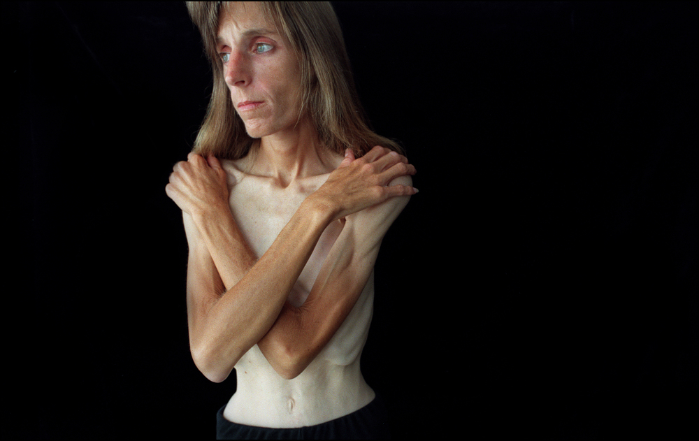   In June 1999 Kathy Spencer weighed 60 pounds, one of her lowest weights during her 12-year battle with anorexia. Kathy died at the age of 41, on March, 8, 2008 in Scottsdale Arizona.  &nbsp;   © Lisa Krantz/Naples Daily News   