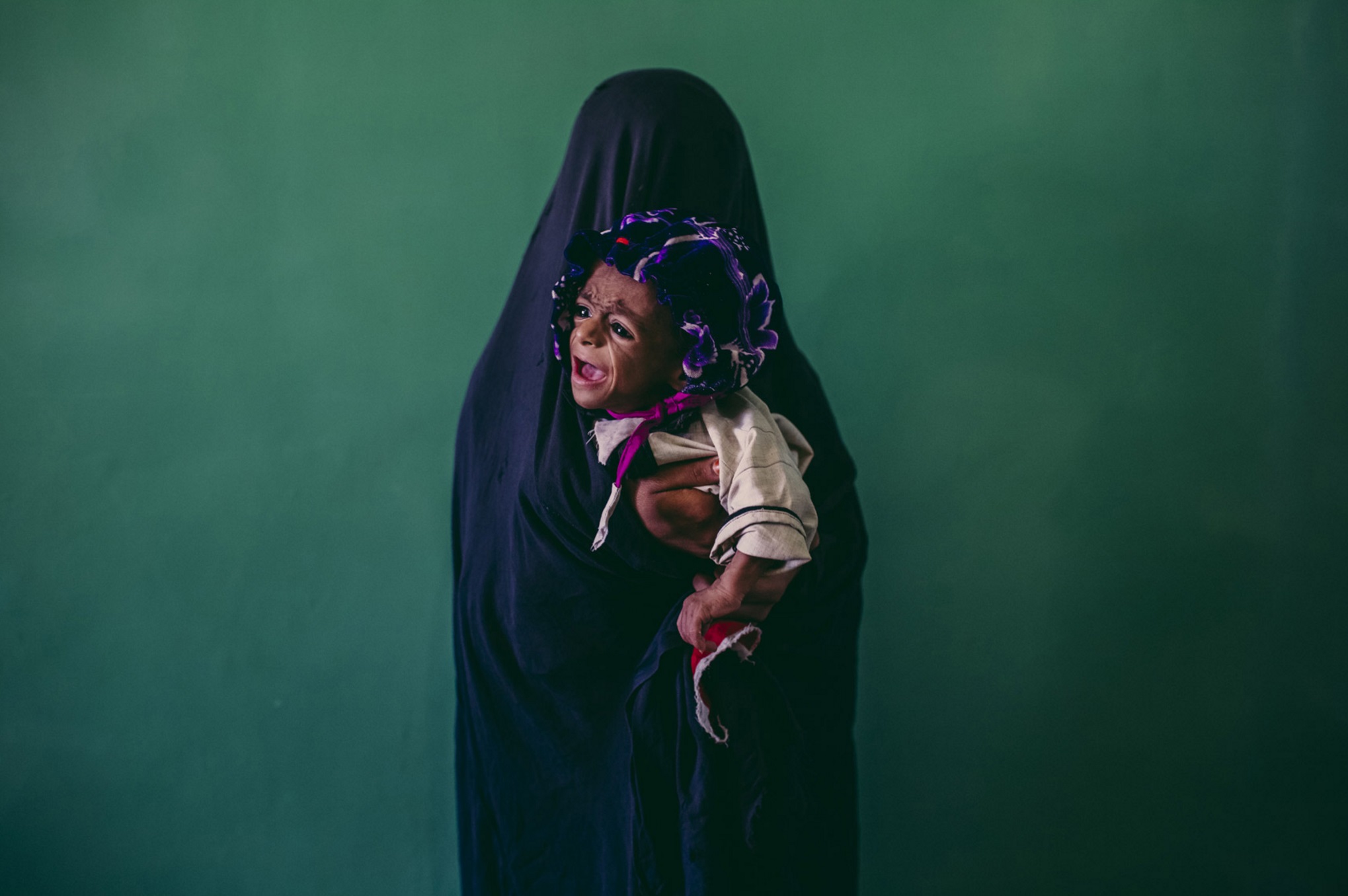 8-month-old Samiullah, suffering from Marasmus, a sign of advanced malnutrition in which the child’s face looks like that of a wrinkled old man, is held by his mother Islam Bibi, 15, as they await treatment at Bost Hospital in Lashkar Gah, Afghanistan. September 23, 2013 © Daniel Berehulak for The New York Times