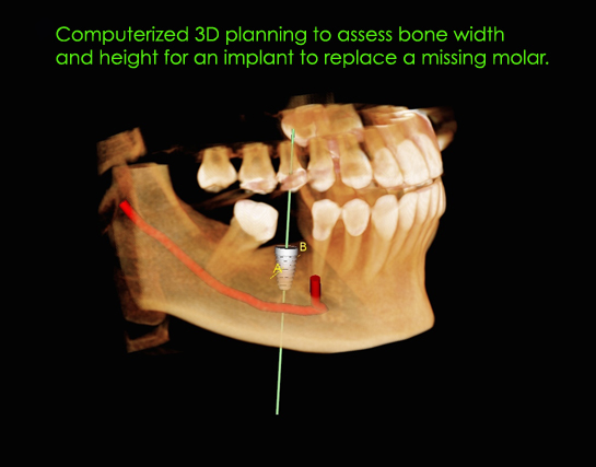 alexnguyendds-implantplanning-version-4.jpg