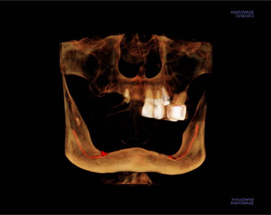 alex-nguyen-dds-deficient-bone-implantview.jpg