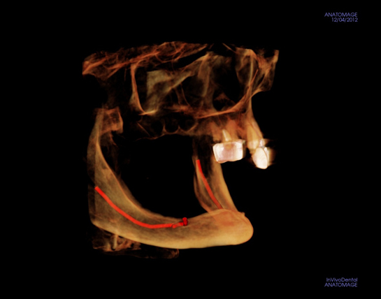 alex-nguyen-dds-deficient-bone-implantview1_2.jpg